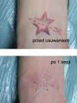 usuwanie tatuażu kolorowego